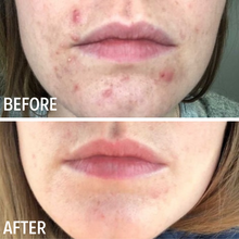 Load image into Gallery viewer, Acne Clearing Gel from Evolve Skin Care Before and After photo