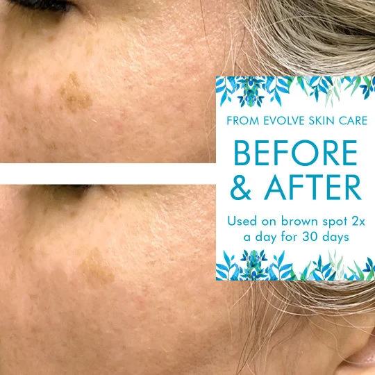 Naturally Lighten Brown Spots with our Brighten Up Serum