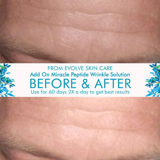 Fighting Wrinkles and Need a Natural Lift?