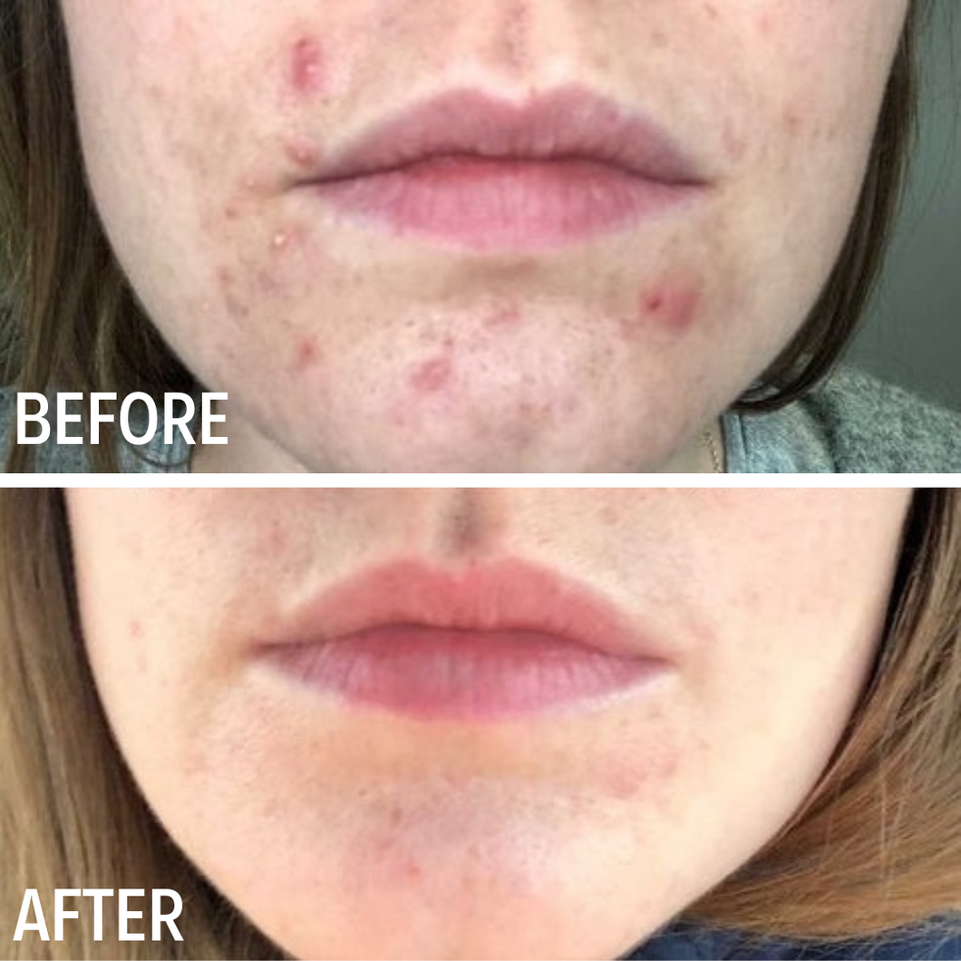 Acne Clearing Gel from Evolve Skin Care Before and After photo